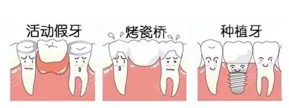 缺牙修复方式