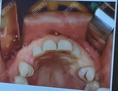 牙槽骨骨增量手术风险大吗？来看植骨粉种植牙经历分享！