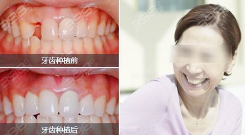 咸宁种植牙医生的前牙种植案例