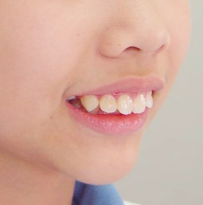 怎么判断龅牙是骨性还是牙性？有改善龅牙方式吗？