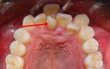 不良咬合关系对牙齿的影响