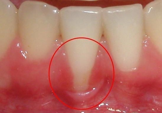 千万不要洗牙，洗完后牙齿敏感肯定洗坏！这是真的吗？