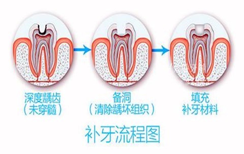 看图更直观了解光固化树脂补牙的步骤，补牙注意事项不能轻视