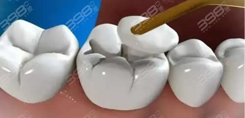 光固化树脂补牙步骤