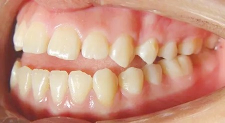 牙齿矫正后为什么会复发反弹？