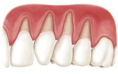 牙龈移植术是什么？来了解牙龈修补术的优缺点