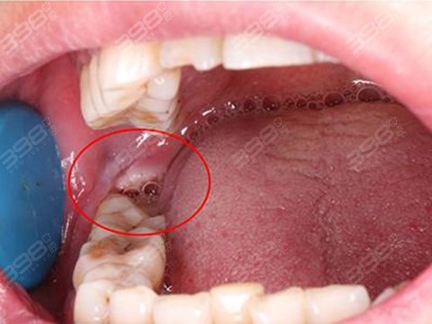 智齿冠周炎脓肿图片见过吗能自愈吗这几个处理方法了解下