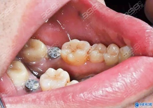 汉中种植牙技术好的医院是哪家？排名榜有吗？求种植牙价格表！