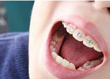 不同年龄阶段牙齿矫正时间，这三个时期不要错过