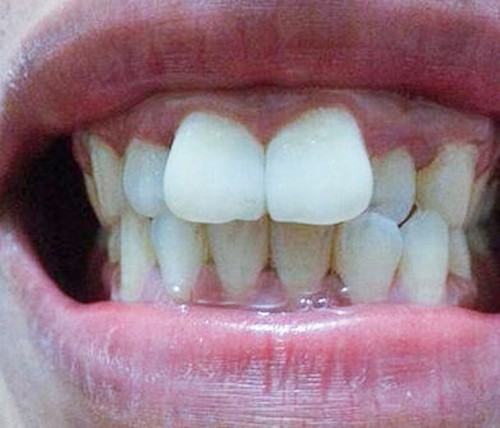 门牙突出用手按有效吗？40岁门牙突出最快矫正方法是什么？
