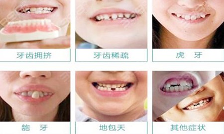 儿童牙齿问题类型
