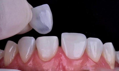 美白牙齿做牙贴面可以维持多久？有后遗症吗？费用一般多少钱？