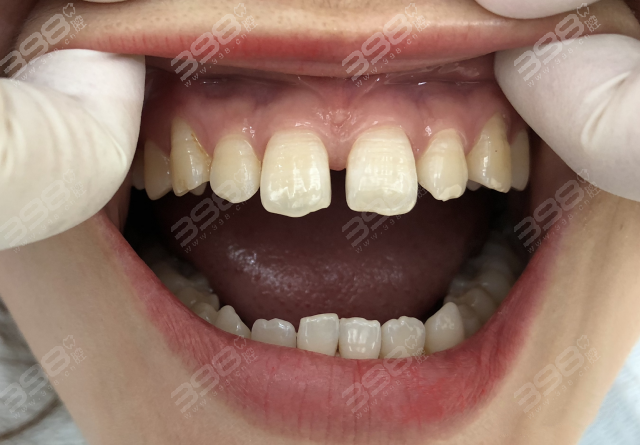 牙缝大，牙齿稀疏