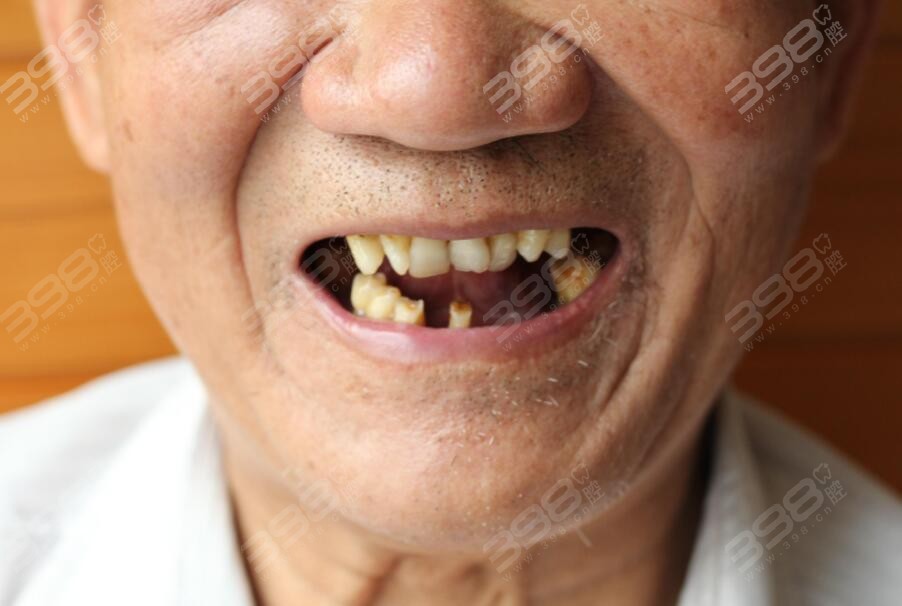 牙齿缺失的老年人