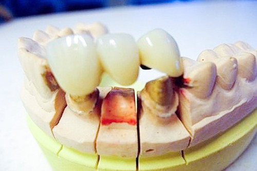做全瓷牙的人的经历：缺失一颗牙做3连桥的利弊一定要知道