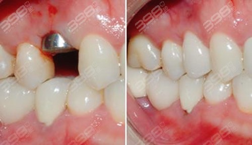 牙齿缺失修复的较好办法-种植牙