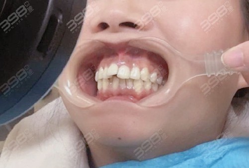 牙齿矫正案例
