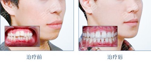 怎样判断你是轻微龅牙？矫正需要拔牙齿吗？会改变脸型吗？