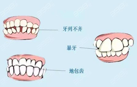 矫正的牙齿类型