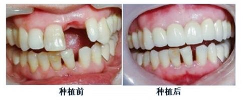 这份西安种植牙医院排名榜一定要查收，有种植牙医生推荐哦！