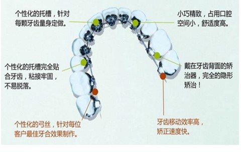 广州能做舌侧矫正的认证医生有哪些？一般需要多少钱？