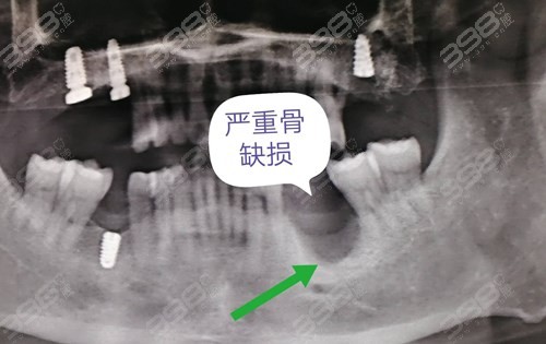 牙槽骨萎缩能种牙吗