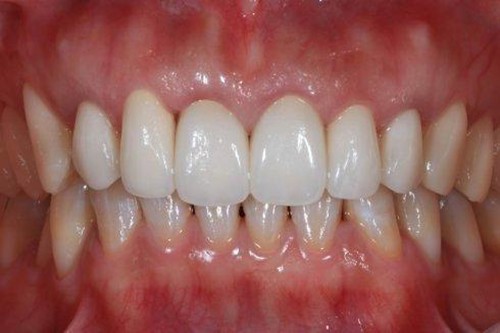 细说嵌体补牙和带牙冠哪个贵？二者到底有什么区别？