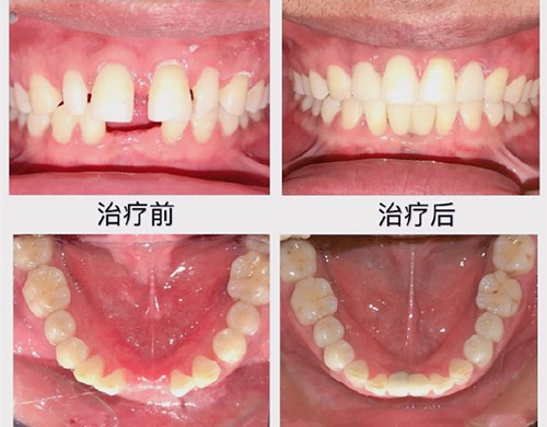 上海长宁区做种植牙好的医院有哪些？这三家牙科正规且便宜来看看