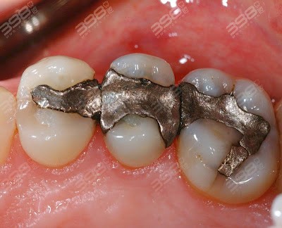 补牙用什么材料好解析补牙材料150和300的区别