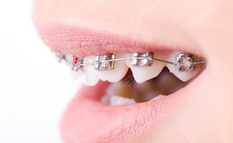 二次牙齿矫正会更难吗？