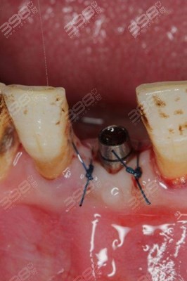 种植牙有哪些风险和后遗症