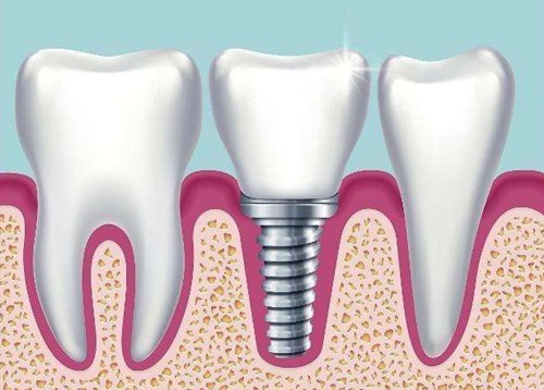 网评西安雁塔区种植牙医院排行，这几家牙科技术很不错！