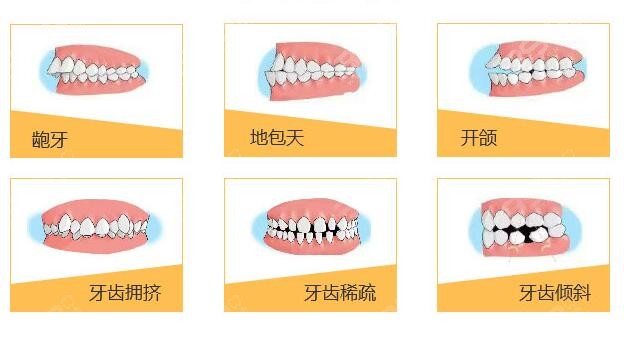 牙齿畸形种类
