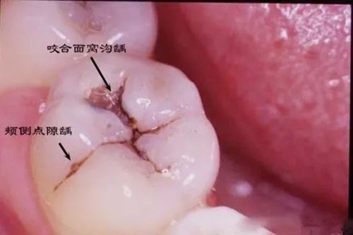 惠州补牙去哪个医院好？在惠州补牙可以用医保吗？