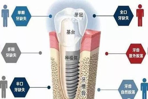 广州哪个医院种植牙便宜又好？看广州正规牙科盘点及医生推荐