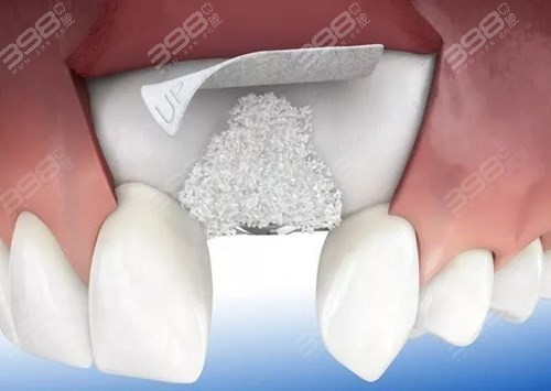 种植牙骨胶原和骨粉的区别有哪些