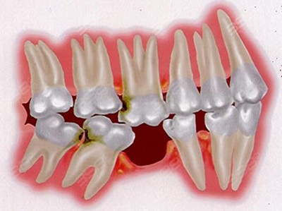 牙齿什么情况下需要植骨粉
