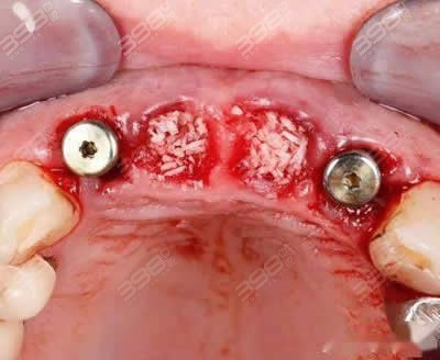 牙齿什么情况下需要植骨粉