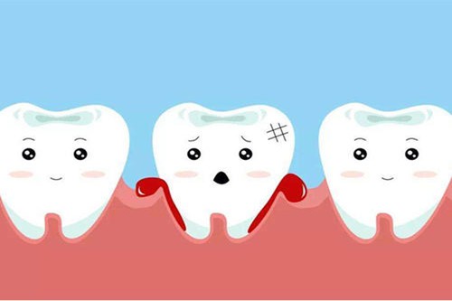 经常刷牙出血是什么原因？牙龈出血该如何治疗？
