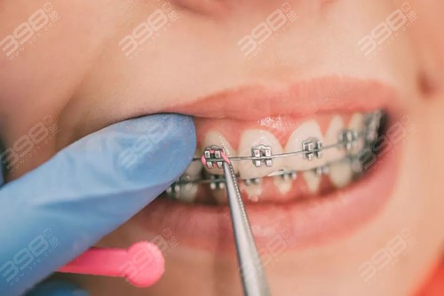 金属矫正牙齿大概多少钱？