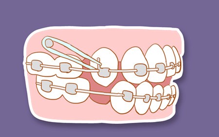 牙齿矫正骨钉作用有哪些？一般什么情况下需要打骨钉