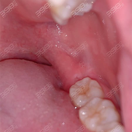 拔牙5天后牙窝愈合过程图