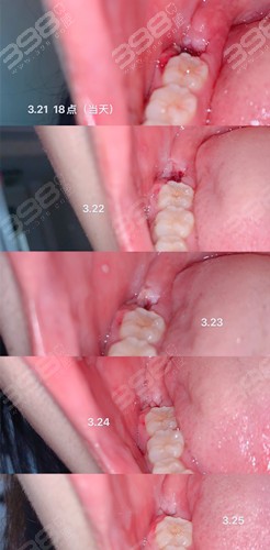拔牙5天后牙窝愈合过程图