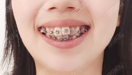 牙齿矫正的作用