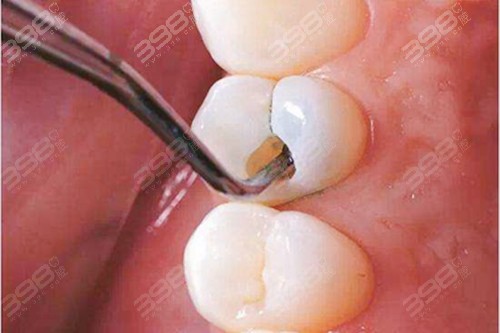 宁愿虫牙继续蛀也不愿意补牙?了解一下蛀牙长期不补的危害!