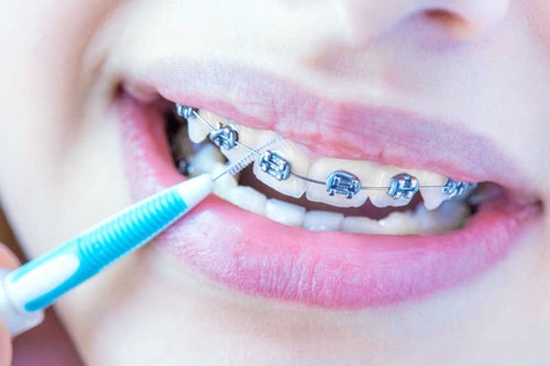 二次矫正牙齿会不会有风险？效果是不是不好？