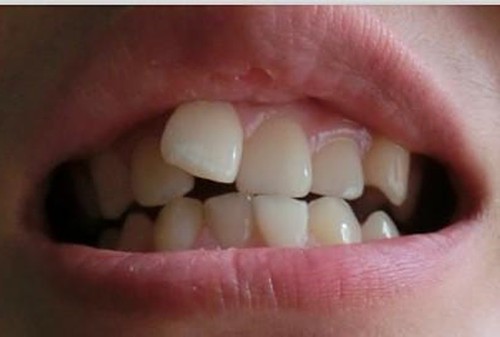 牙齿矫正后反弹了怎么办？是不是必须重新整？