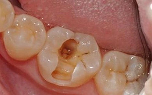 牙齿烂洞长期不补会怎样？为什么有人说千万不要去补牙洞？