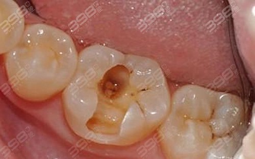 牙齿烂洞长期不补会怎样？