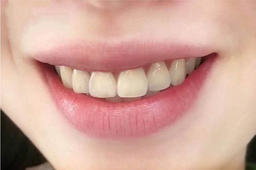 牙齿美白对牙齿有伤害吗？看了这篇让你秒懂